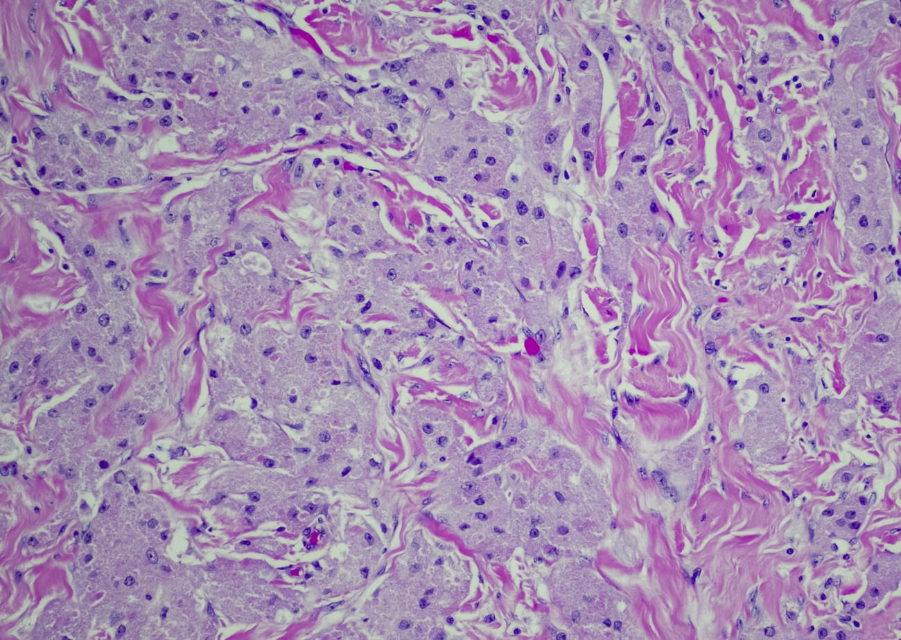 Photo shows a microscopic view of granulosa cell tumor is shown