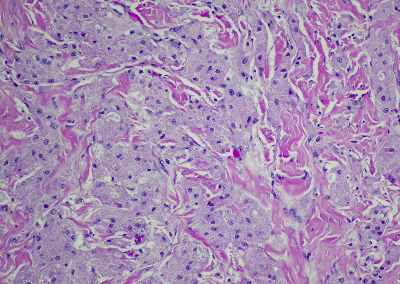 Photo shows a microscopic view of granulosa cell tumor is shown