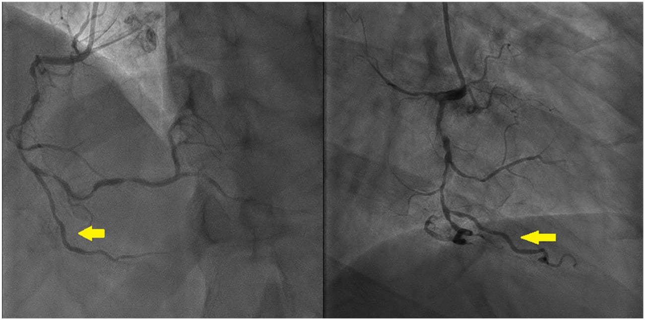 CABG Image