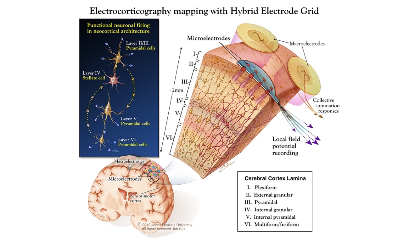 A medical illustration details a hybrid electrode grid implanted in the brain to record neurostimulation activity