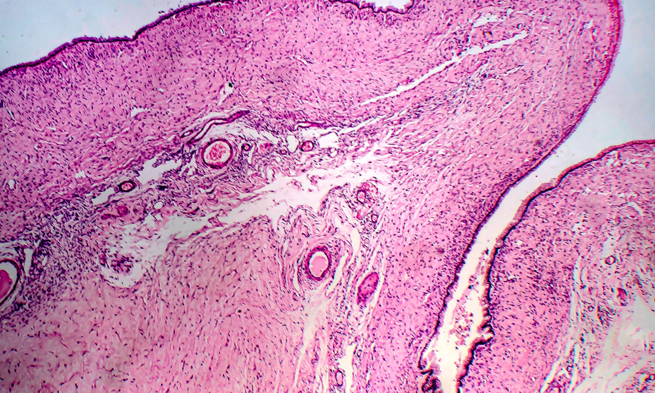 A light micrograph shows an ovarian cyst in pink and purple colors