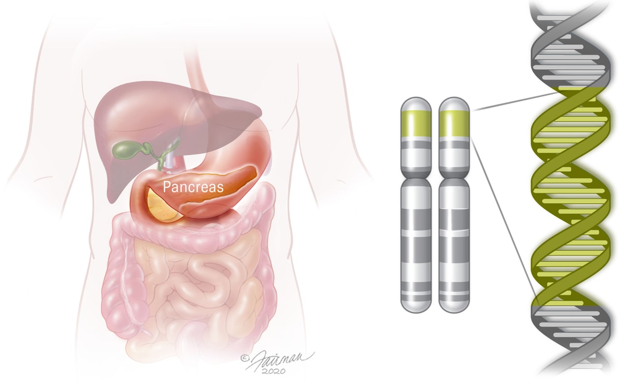 PancreatitisHero