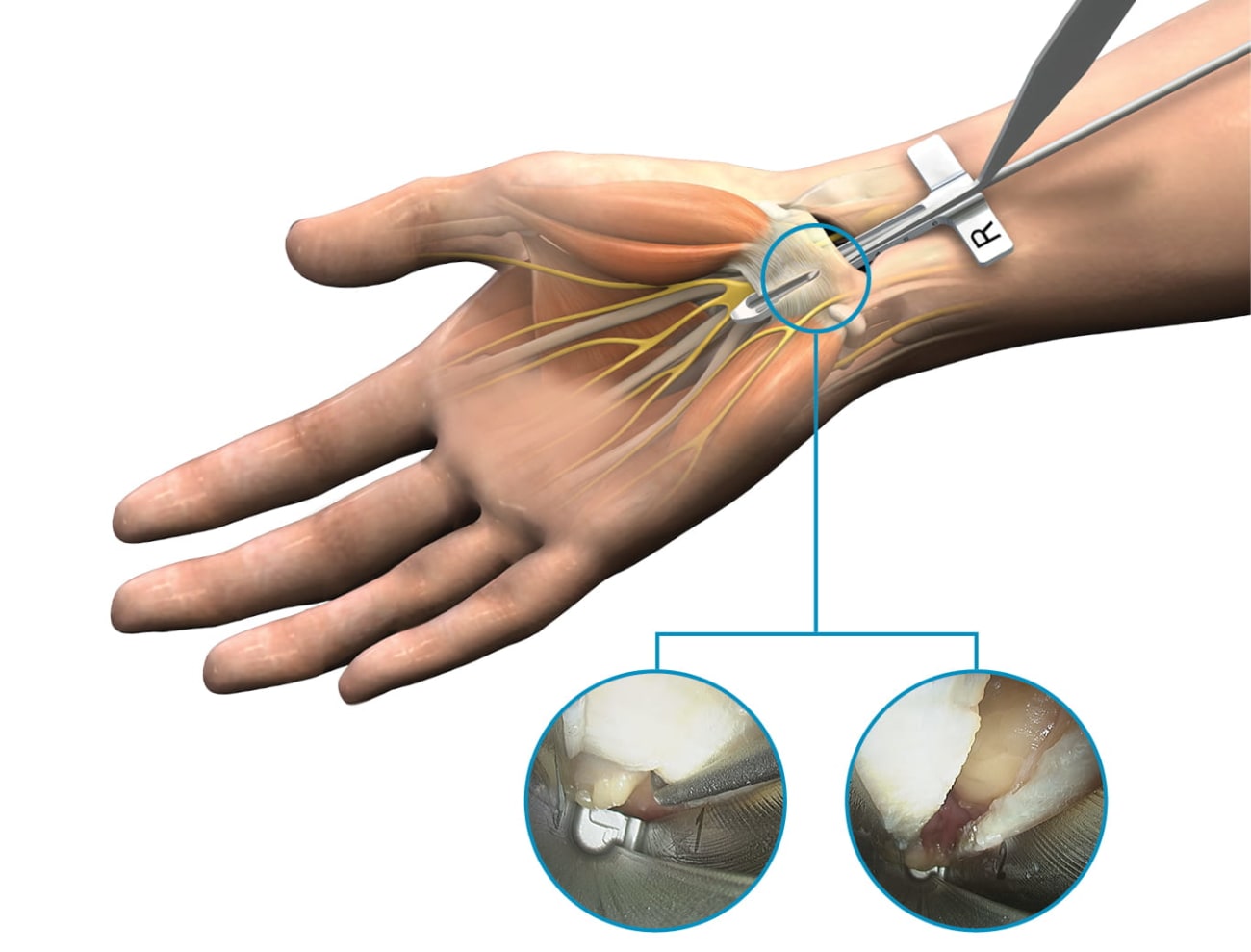 endoscopic release kit