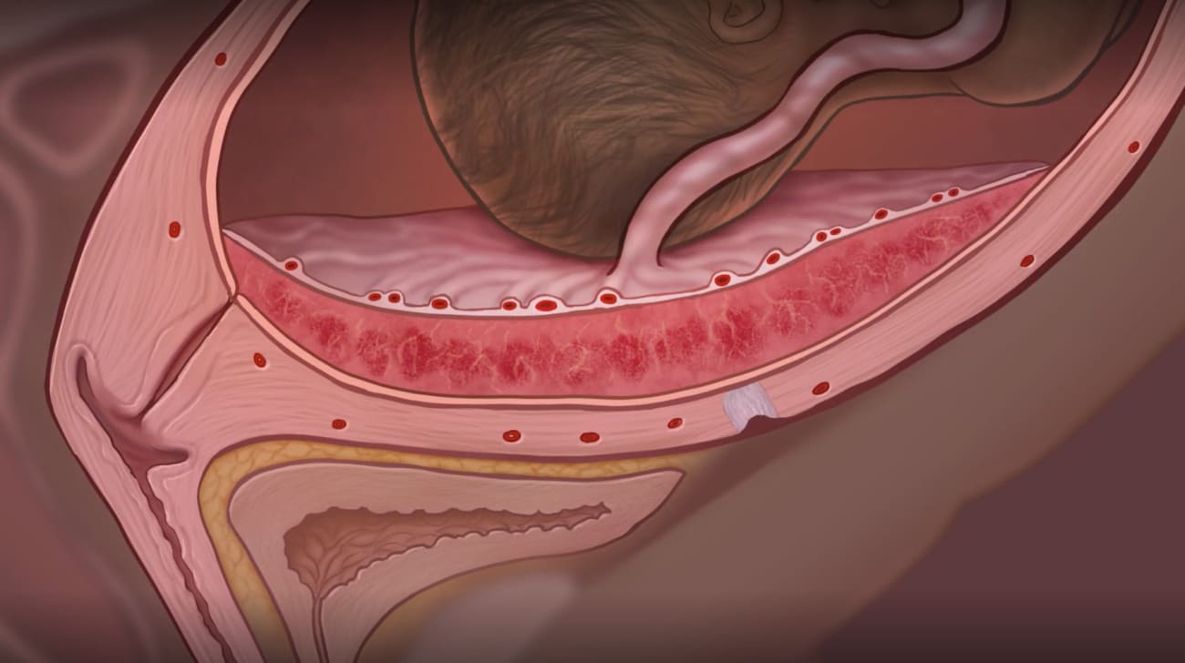 A medical illustration depicts placenta accreta, a condition in which placenta grows into the uterus or other nearby organs