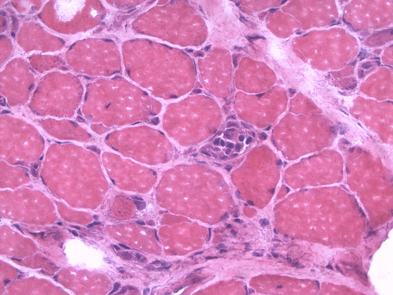 This quadriceps muscle biopsy shows myofiber atrophy, endomysial fibrosis, myofiber degeneration, regeneration, necrosis and myophagocytosis.<br />(Image courtesy of Andrea Corse, M.D.)