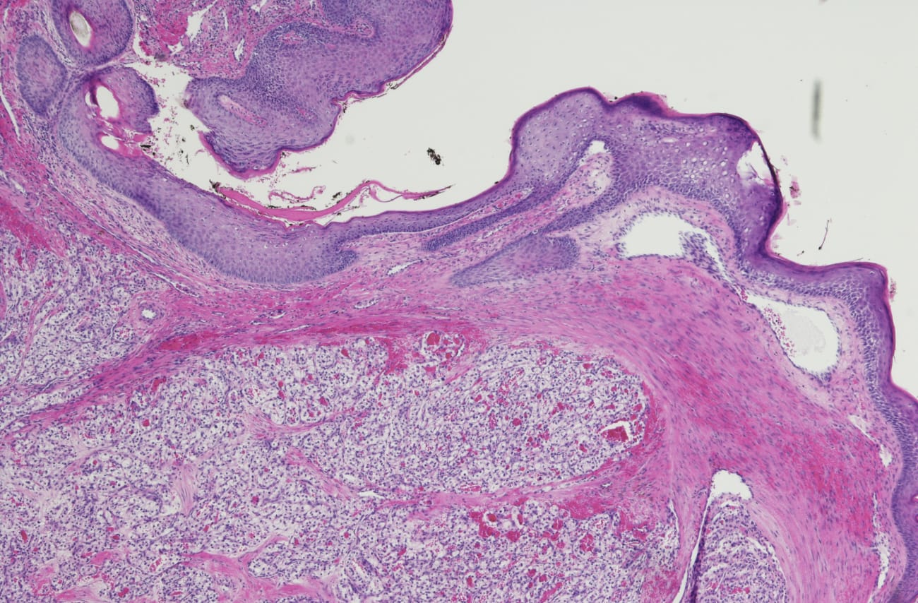 Shedding Light on the Trickle-Down Effect of Mutated Genes in Kidney Cancer