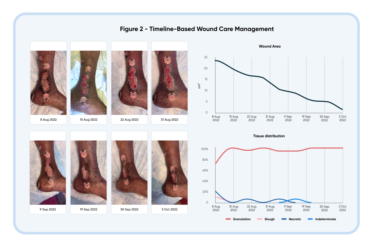 scleroderma