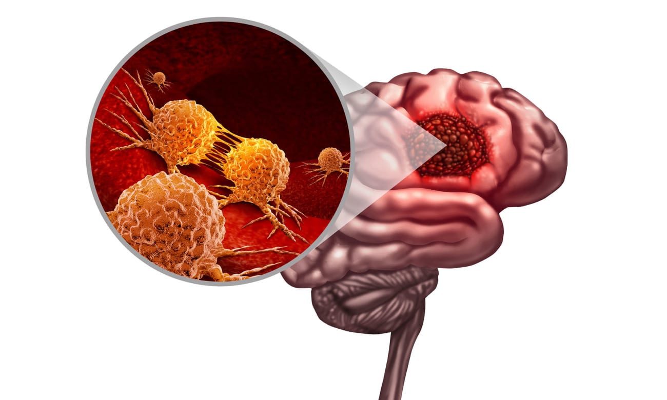 A medical illustration of brain cancer