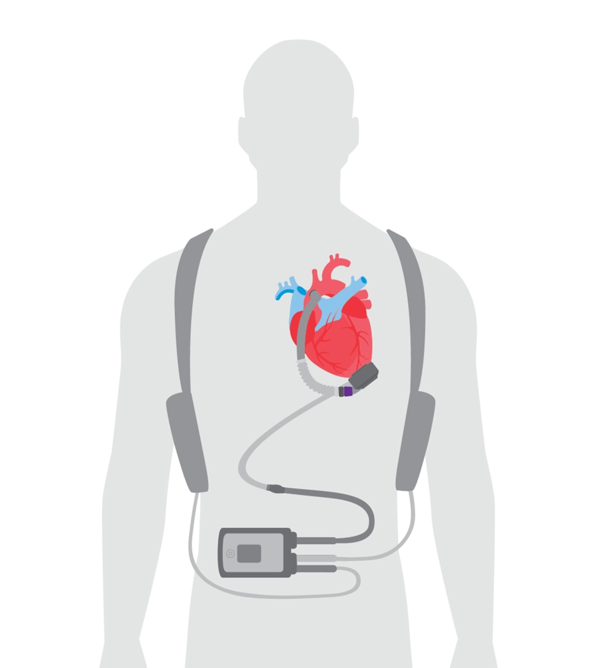 Lvad Bag 