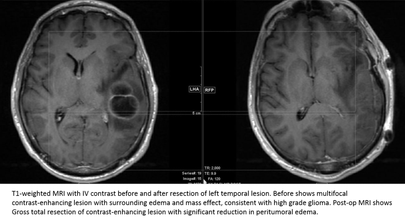 T1-weighted MRI with IV contrast before and after resection of left temporal lesion