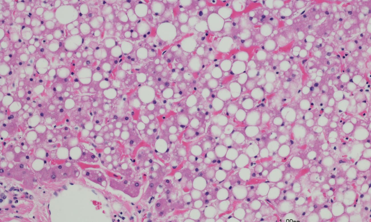 Destigmatizing Liver Transplant for Patients with Alcohol Use Disorder