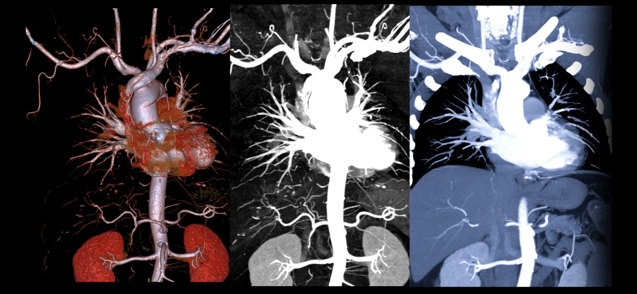 Aortogene Panel Role of Genetic Testing in the Management of Aortic Disease - Keck ...