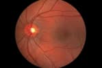 Retinopathy of Prematurity (ROP): Treatment and Results