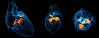 Transcatheter Pulmonary Valve Replacement in Congenital Heart Disease