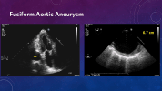 Breaking Down Updated Aortic Guidelines for Echocardiographers