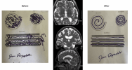 High Intensity Focused Ultrasound (HIFU) & Essential Tremor