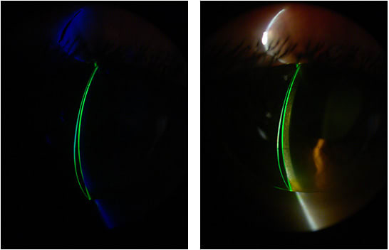 Figure 3. Lens profile in cross-section view under cobalt blue (left) and white (right) light.