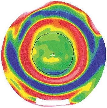 Figure 10. Topographical map showing good centration of the treatment zone in orthokeratology.