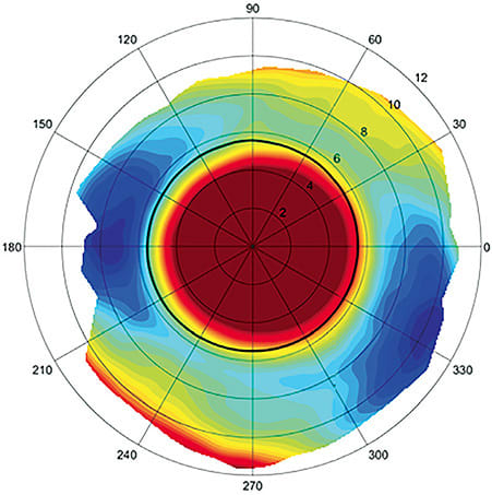 Figure 4. Profilometry of the sclera demonstrating regular toricity. The meridian from 1 o’clock to 7 o’clock is more elevated and thus a flatter slope. The meridian from 4 o’clock to 10 o’clock is deeper and therefore a steeper slope. Image courtesy of Jason Jedlicka, OD