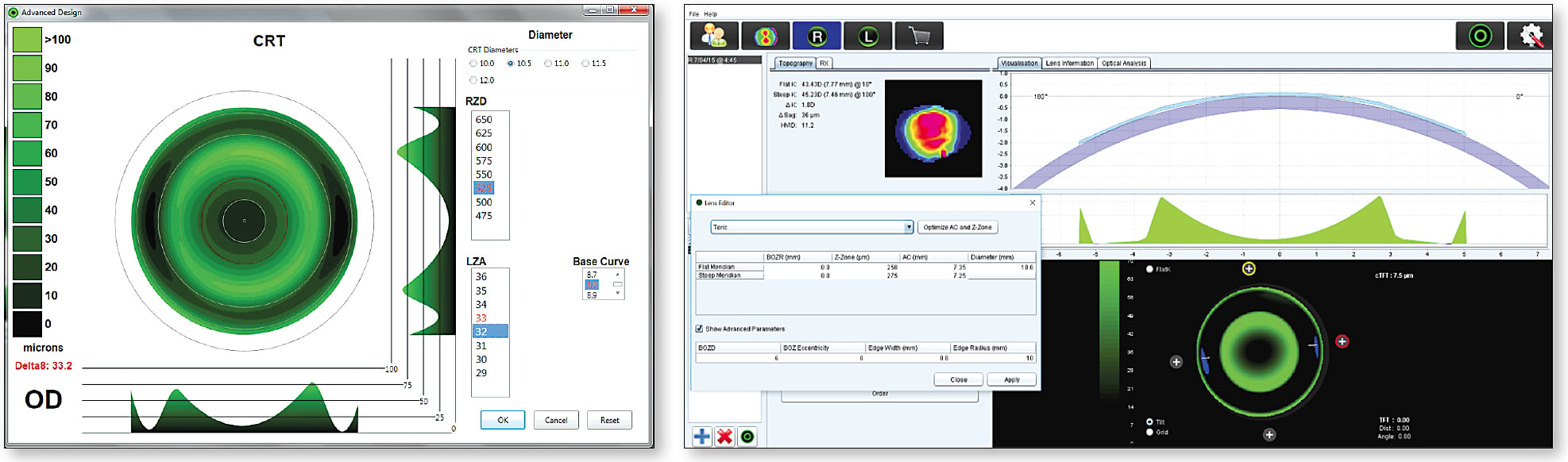 Figure 12. Examples of “virtual” fitting software for corneal reshaping.
