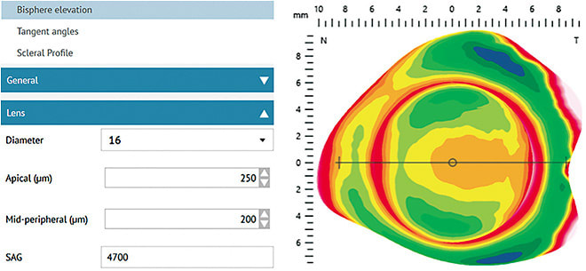 Figure 8. At a diameter of 16.0mm, this eye needs a sag of 4700. Choose the diagnostic lens in your set closest to 4700. Image courtesy of Jason Jedlicka, OD