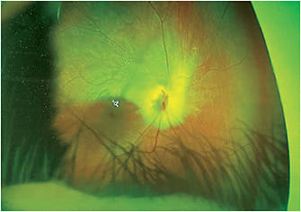 Figure 1. Retinal myelination caused unilateral high myopia in this 1-year-old infant.