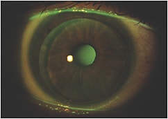 Figure 2. Aspheric GP multifocal fit on the right eye.