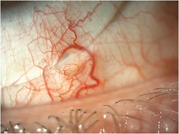 Figure 1. Inclusion epithelial cysts fit with a micro vault.
