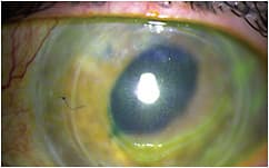 Figure 1. An eye post-multiple keratoplasty procedures, where scleral lens use is contraindicated for the management of chronic ocular surface pain.