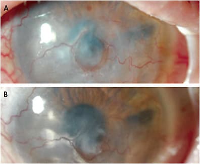 Figure 8. (A) Stabilization of the ocular surface in a SJS patient status post-corneal melt with the lens in Figure 7. (B) Four months after refitting, the ocular surface continues to be supported by the scleral lens, with no signs or symptoms of edema/bullae, and there is evidence of decreased vascularization and haze/opacity.
Images courtesy of Karen G. Carrasquillo, OD, PhD