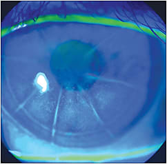 Figure 2. Radial keratotomy scarring incisions inside pupil margins can cause distorted, blurry vision, even with the best specialty lens.