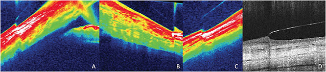 Figure 3. AS-OCT reveals a sharp circumferential lens edge as the true culprit behind lens discomfort. (A) Temporal edge, (B) Nasal edge, (C) Superior edge, (D) Traditional rounded edge.