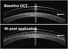 Figure 3. A turbid tear reservoir is observed after four hours of lens wear. Photo courtesy of Maria Walker, OD
