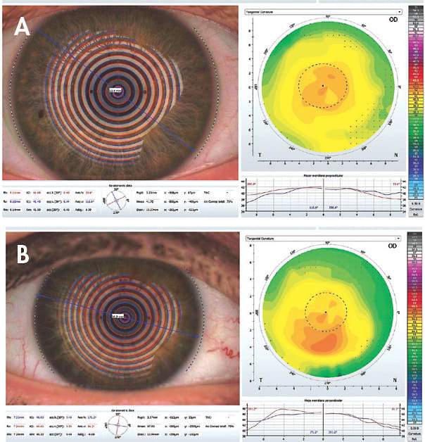 Figure 1. (A) Average K value of 41.50D, horizontal visible iris diameter (HVID) of 13.0mm. (B) Average K value of 46.30D, HVID = 10.9mm.