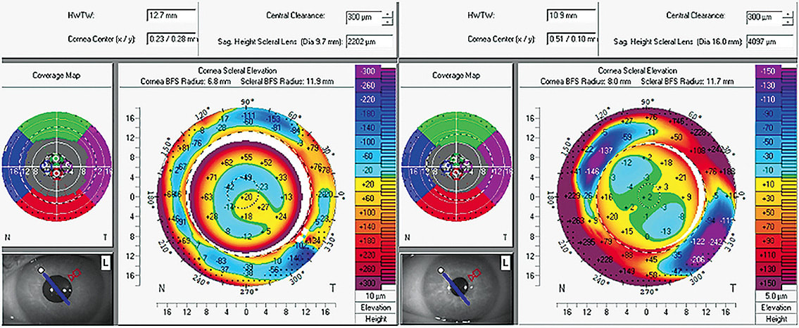 Figure 7. Profilometry of two patients: the one on the left has a white-to-white of 12.7, and the one on the left has one of 10.9. These patients would be best served using scleral lenses of different diameters. Image courtesy of Jason Jedlicka, OD