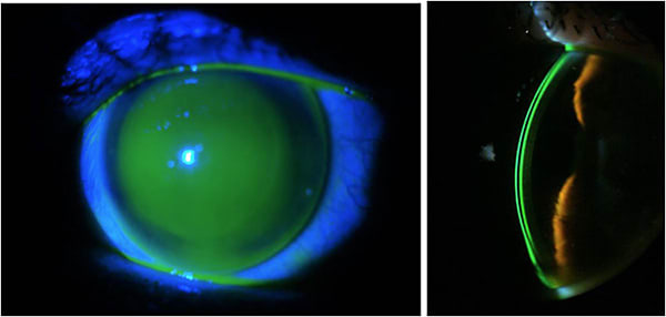 Figures 17 and 18. Frontal and cross-section view of the intralimbal GP fitting OS.