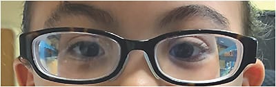 Figure 1. Marfan syndrome can cause high myopia, astigmatism, and anisometropia.