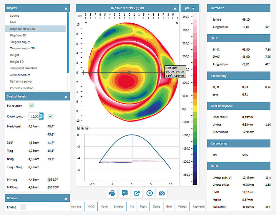 Figure 1. Corneoscleral profiler showing ocular sagittal height and presence of scleral toricity or asymmetry. The software calculates the first lens sagittal height and lens toricity for a selected lens of a specific diameter. In this case, a pinguecula is also detected, and its depth, position, and width are shown.Image courtesy of Martin Conway.