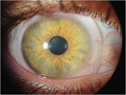 Figure 1. Frontal Image Biomicroscopy
