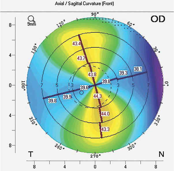 Figure 1. Corneal topography axial map of the right eye.