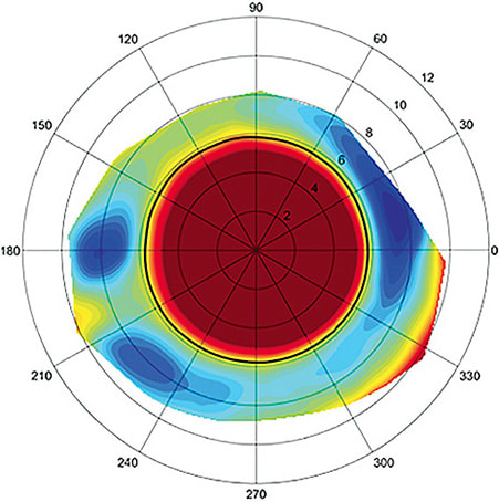 Figure 5. Profilometry of the sclera demonstrating regular toricity but with an area of elevation running through the temporal deep meridian. This elevated zone was evident with a diagnostic lens on and required lens modification to accommodate. The profilometer allowed for measurement of the width and depth of the elevation to create a localized vault. Image courtesy of Jason Jedlicka, OD