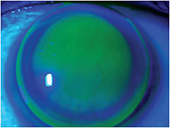 Figure 9. A steep-fitting toric corneal GP contact lens on a toric cornea.