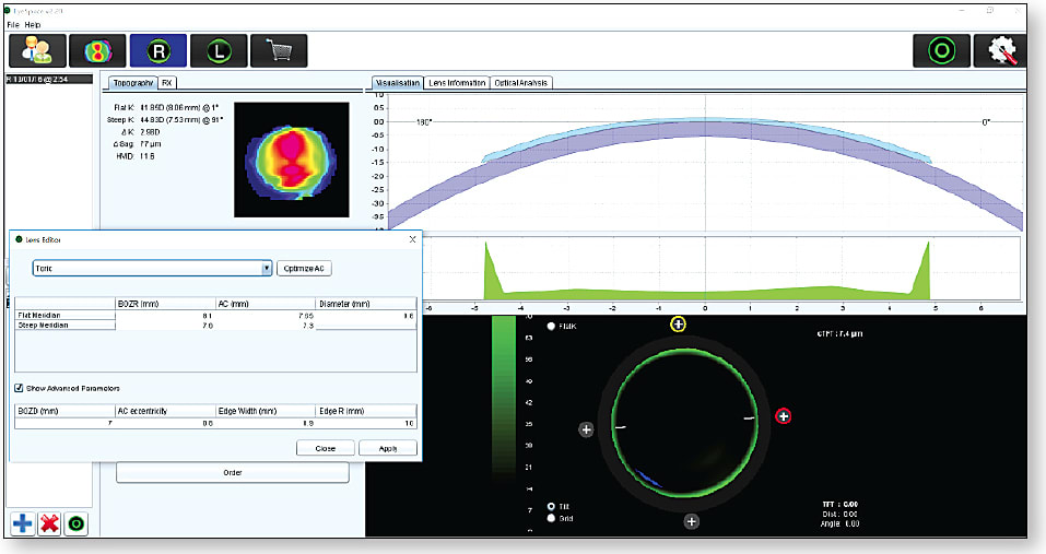 Figure 5. Virtual corneal GP fitting. This software can be utilized with a number of different topography systems.