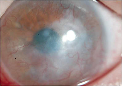 Figure 5. Left eye of a SJS patient fitted with a 19.5mm, eight-meridian custom scleral lens since 2006.
Images courtesy of Karen G. Carrasquillo, OD, PhD