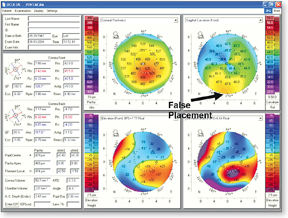 Figure 6. Tomography display of a keratoconic cornea showing the true location of the cone apex based upon elevation and global pachymetry maps, not a curvature map.