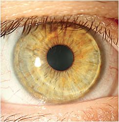 Figure 6. Case 4 lens fit OD.