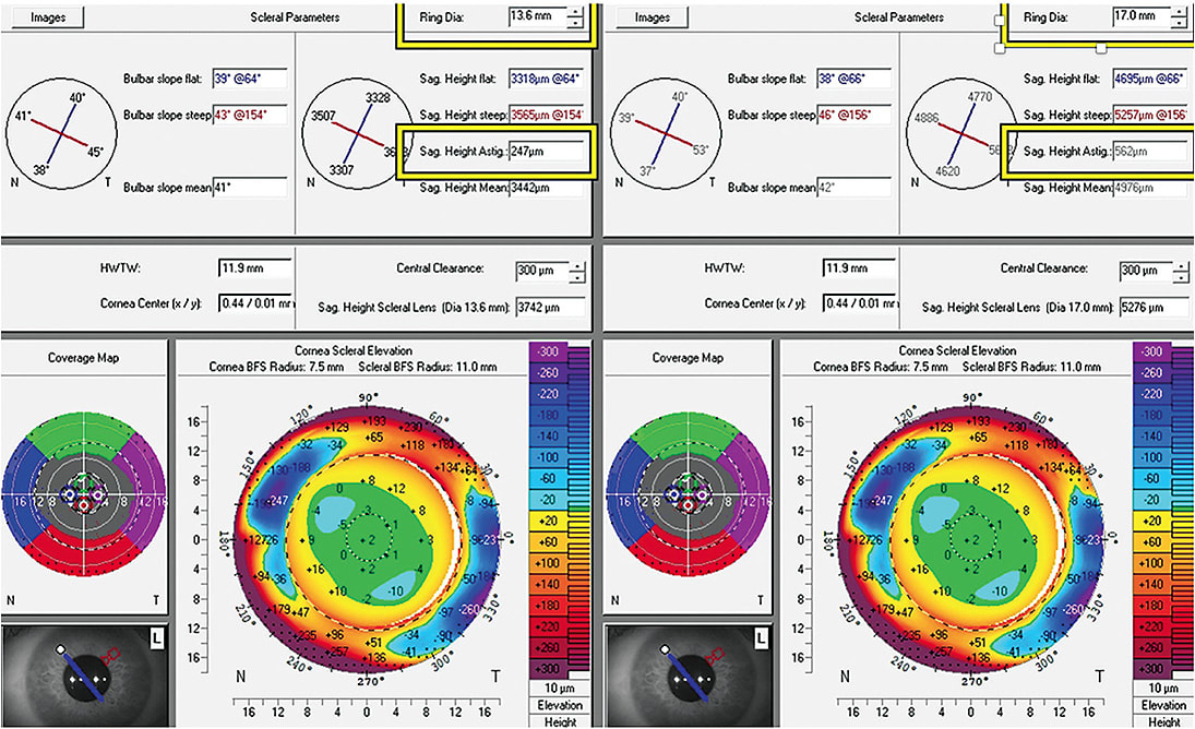 Figure 13. Profilometry of the left eye. On the right, at a ring diameter of 17mm, the patient has 562 microns of toricity. On the left, at a ring diameter of 13.6mm, she has 247 microns of toricity. Compensating for the full toricity in the periphery alone was inadequate to achieve an acceptable fit. Image courtesy of Jason Jedlicka, OD