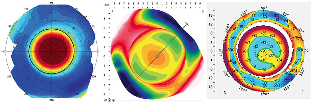 Figure 9. Three eyes with distinctly different scleral shapes: spherical, toric, and quadrant-specific. Choose a diagnostic lens with the appropriate scleral zone, if possible. Image courtesy of Jason Jedlicka, OD