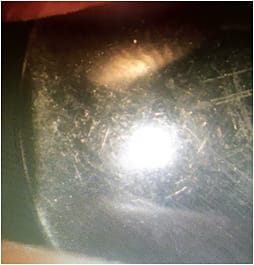 Figure 1. Warped, scratched, and hazed orthokeratology lens with front-surface deposits.