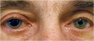 Figure 7. Pupil asymmetry following blunt trauma to the right eye.